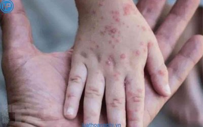  KHUYẾN CÁO PHÒNG CHỐNG BỆNH ĐẬU MÙA KHỈ (MPOX)